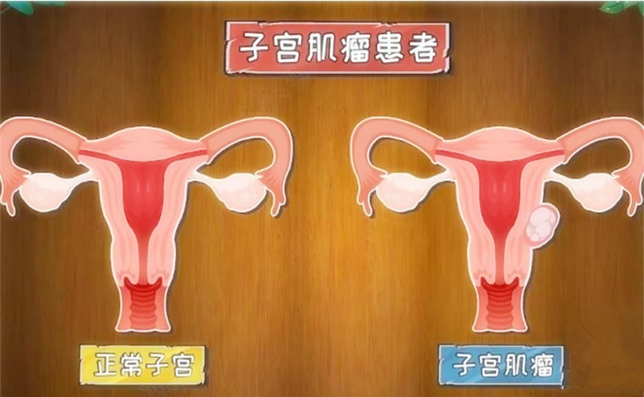 子宫问题导致不孕不育的原因有哪些？