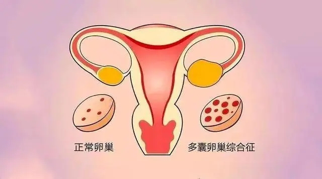 多囊性卵巢综合征的特征