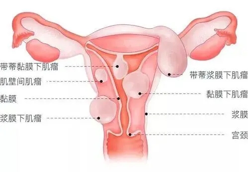 1／4的不孕均与子宫肌瘤有关，若月经量多就得小心了！