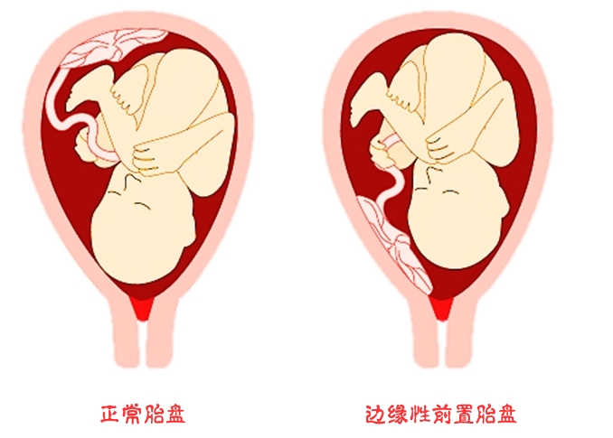 胎盘前壁和胎盘后壁、前置胎盘各是什么意思区别是?